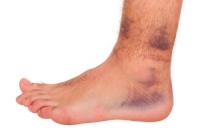 Sprained Ankles Are a Common Injury