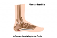 Reasons Why Plantar Fasciitis Can Develop